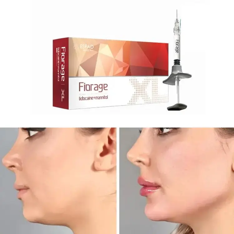 فیلر فیوریج XL